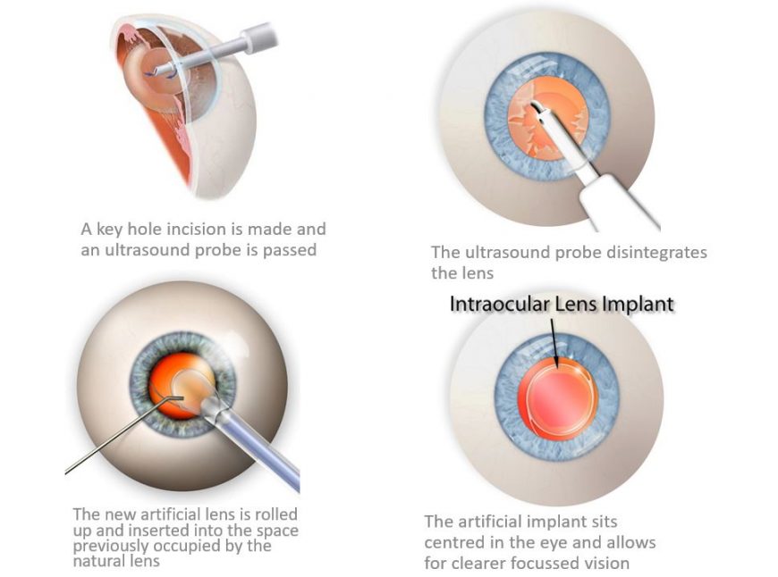 verkenner telescoop terwijl Eye Lens Replacement Surgery - Premium Lens Implant Surgery UK