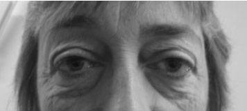 Before and after image cosmetic eye surgery