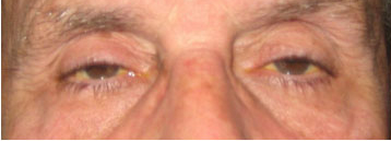Cosmetic eye surgery