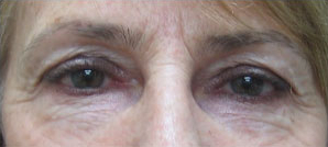 Cosmetic eye surgery