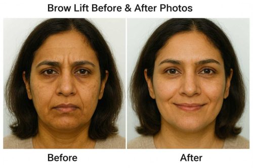 Before And After Photos Brow Lift Surgery